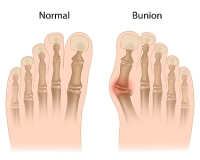 Various Types of Bunions